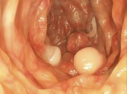 Colon Polyps And Your Cancer Risk