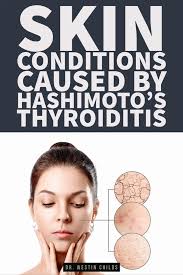 15 skin conditions caused by hashimoto