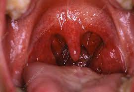 mouth showing normal throat and tonsils