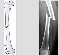 Classification not possible to classify according to weber, but according to lauge hansen a medial avulsion fracture indicates that the foot probably was in pronation at the moment of injury. Fractures Femur Flashcards Memorang