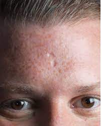cover acne scars acne scar filler for