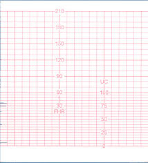 Asf 030 Fetal Monitor Paper 110mm 100mm 150p Chart Paper