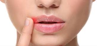 how to quickly treat cold sores