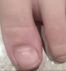 white spots on toenail white spots on
