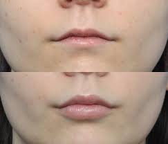 juvederm jacksonville fl ponte vedra