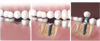 implant dentar clinica stomatologica
