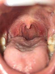 warts in the throat ask the doctor
