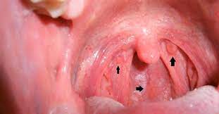How can i tell if i have throat cancer. Soundsultan What You Should Know About Throat Cancer Causes Symptoms Yara Ng