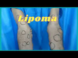 lipoma removal surgery planning of