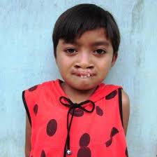 Windari Dwi Prasasti atau yang sering dipanggil Windari merupakan salah satu anak asuh kami yang terlahir dengan bibir sumbing. - 97windari