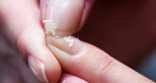 brittle nails can be a sign of anemia