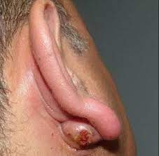 ear lump ear cyst ent specialist
