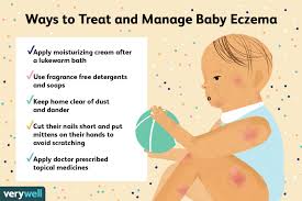 baby eczema symptoms and treatment