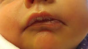 trash or chapped lips babycenter