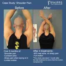 shoulder pain impingement relief