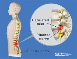 pinched nerve treatment in south