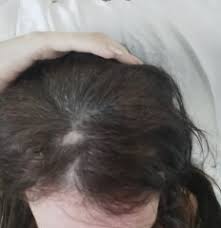 if my hair loss is down to low ferritin