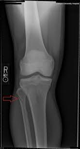 Last updated by data trace staff on tuesday, may 22, 2012 11:01 am Critical Cases Not Just An Ankle Sprain Demystifying The Maisonneuve Fracture Em Daily