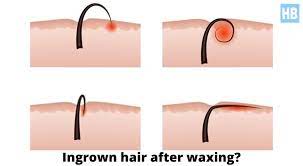 bad ingrown hairs after brazilian wax