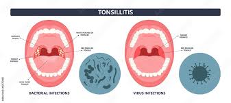 tonsil stones crypts viral virus gland