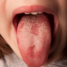 your tongue says about your health