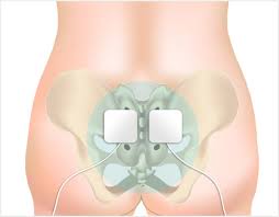 neuromuscular electrical stimulation