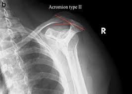 The morphology of the acromion and its relationship to rotator cuff tears. The Effectiveness Of Extracorporeal Shockwave Treatment In Subacromial Impingement Syndrome And Its Relation With Acromion Morphology Abstract Europe Pmc
