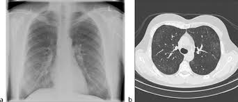Pulmonary Opacity Extensive Pattern