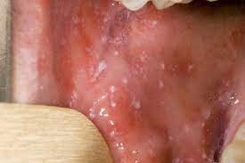 rashes in es and children nhs