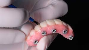 get permanent dentures at kop dental