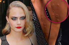 ouch cara delevingne is covered in