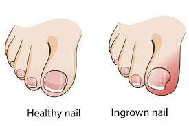 take care of an ingrown toenail before