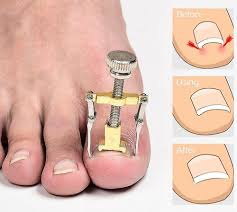 ingrown toenail manicure pedicure foot