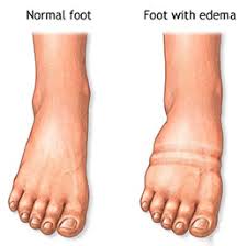 home remes for edema natural treatment