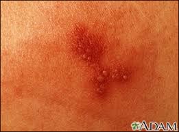 herpes simplex in depth reports st