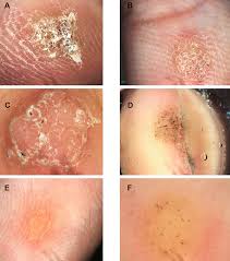 dermoscopy features of cutaneous warts