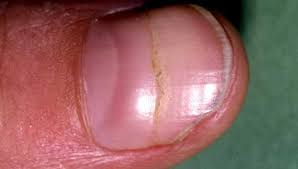 ridges in fingernails symptoms causes