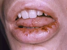 cold sore on lip pictures treatments