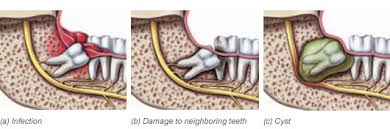 infection near wisdom tooth