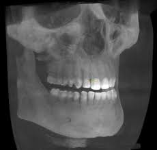 cbct 3d x rays west bluff dental care