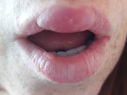 swollen lip warning