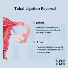 tubal ligation reversal reclaiming