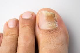 fungal nail infections symptoms