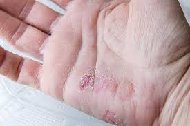 Psoriasis is an autoimmune condition that causes red, scaly skin patches and discomfort on the skin. About Psoriasis Almirall