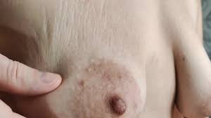 Closeup Saggy Tits with Stretch Marks - Pornhub.com