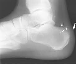 Haglund's syndrome is a group of signs and symptoms consisting of haglund's deformity (which is an exostosis of the posterior calcaneal tuberosity) in combination with retrocalcaneal bursitis. Haglund S Syndrome Diagnosis And Treatment Using Sonography Springerlink