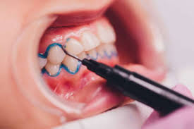 teeth whitening bleaching dental