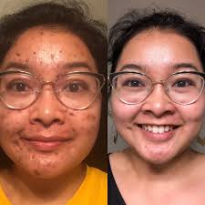acne treatment before afters skin
