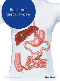 gastric byp surgery dallas fort