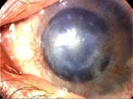 new finding in rare eye disease